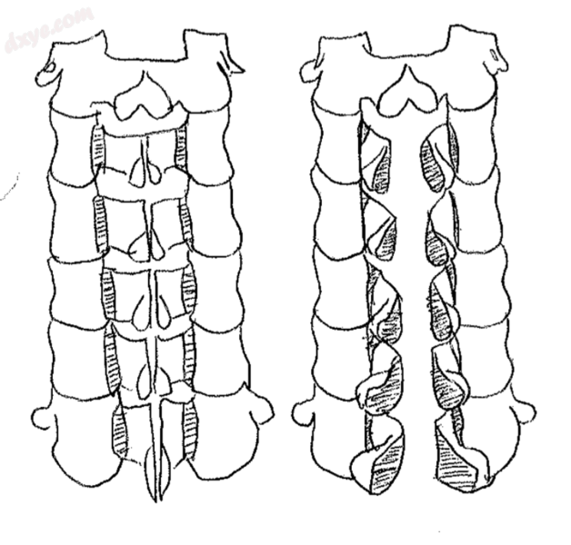 Double Door Laminoplasty - Adapted From R. Kurokawa et al..png