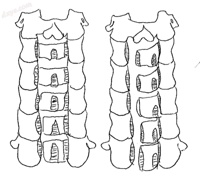 Open Door Laminoplasty - Adapted From R. Kurokawa et al..png