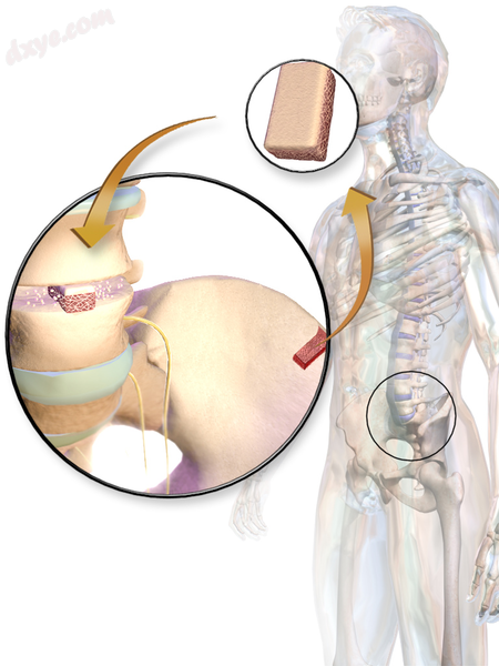 Illustration of an auto移植采集ed from iliac crest..png