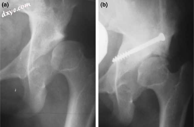 a. X-ray of a hip after capsulorrhaphy and Dega surgery..jpg