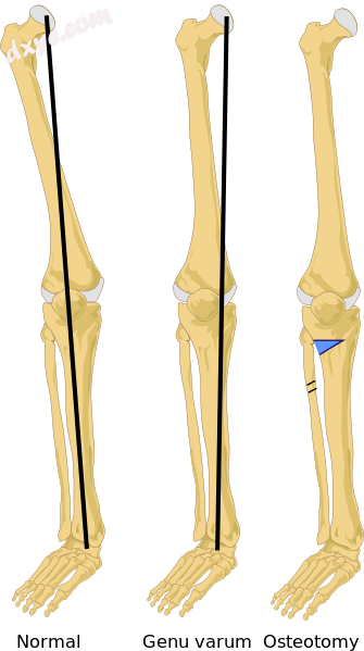 Valgus osteotomy. The black line is the mechanical axis..png