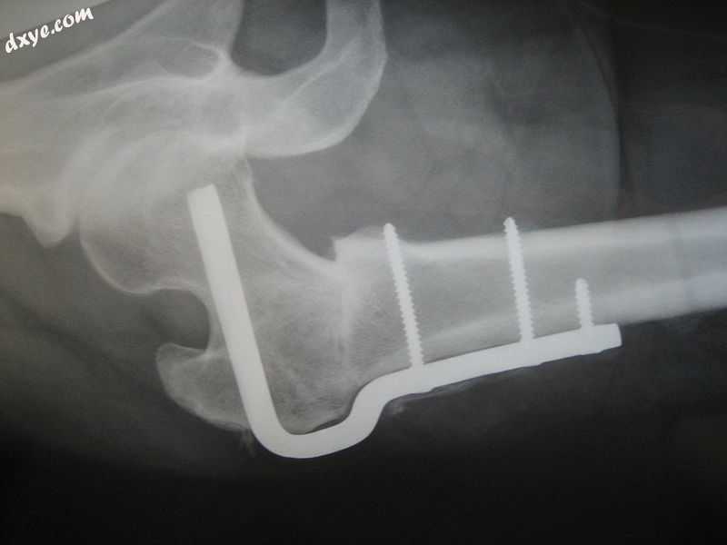 X-ray of Femoral Osteotomy hardware to correct femoral rotation caused by hip dy.jpg