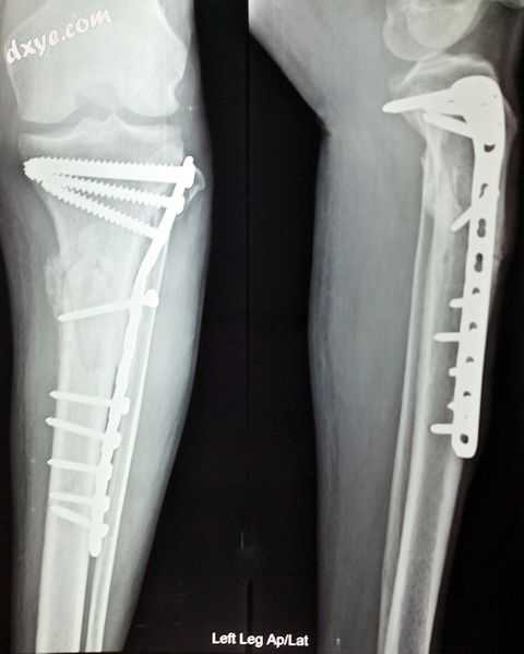 Anterior and lateral view x-rays of fractured left leg with internal fixation.jpg