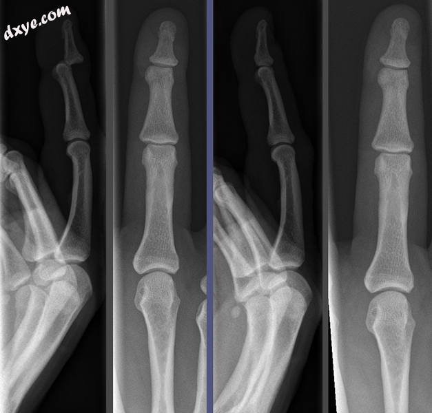 Joint dislocation in the DIP of the third finger before (left images) and after .png