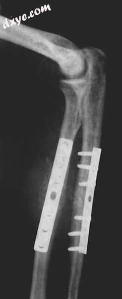 Orthopedic implants to repair fractures to the radius and ulna, note the visible.jpg