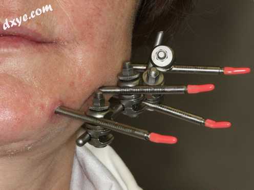 External fixation of the mandible..jpg