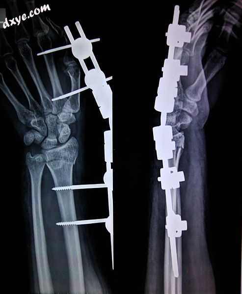 an X-ray image of an external fixator being used for reduction of a broken bone,.jpg