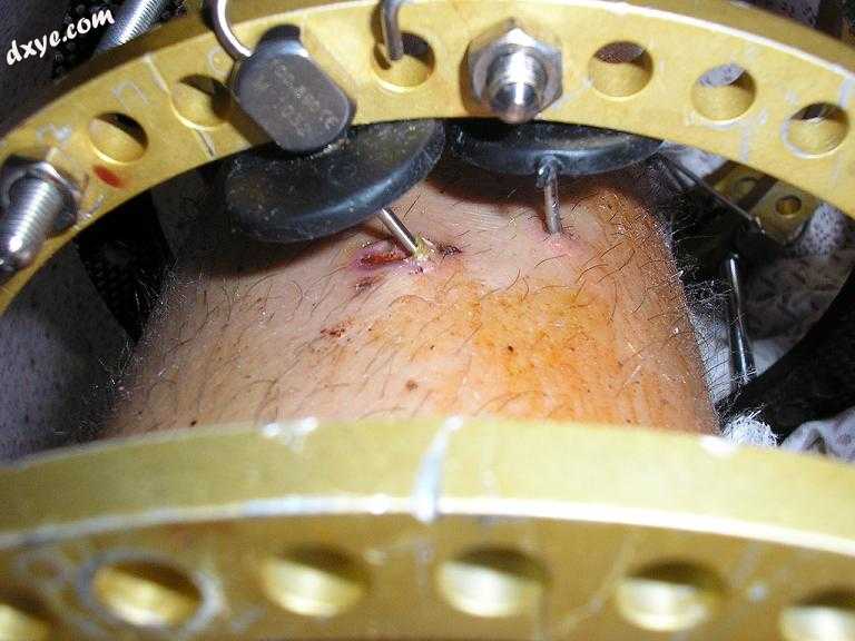 Surgical pins exiting the skin.jpg