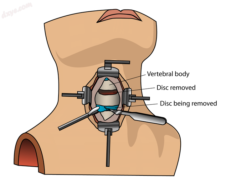 Anterior approach to cervical spine..png