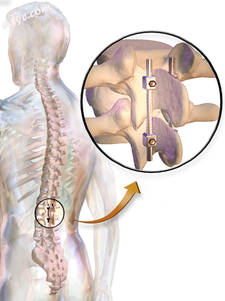 Stabilization rods used after spinal fusion surgery..png