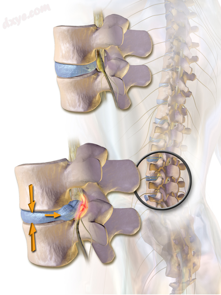 Herniated disc pressing on spinal nerves..png