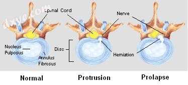 Stages of spinal disc herniation.jpg