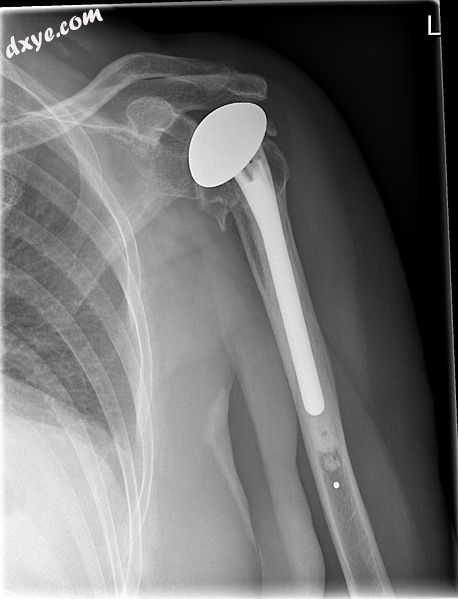X-ray of a shoulder prosthesis.jpg