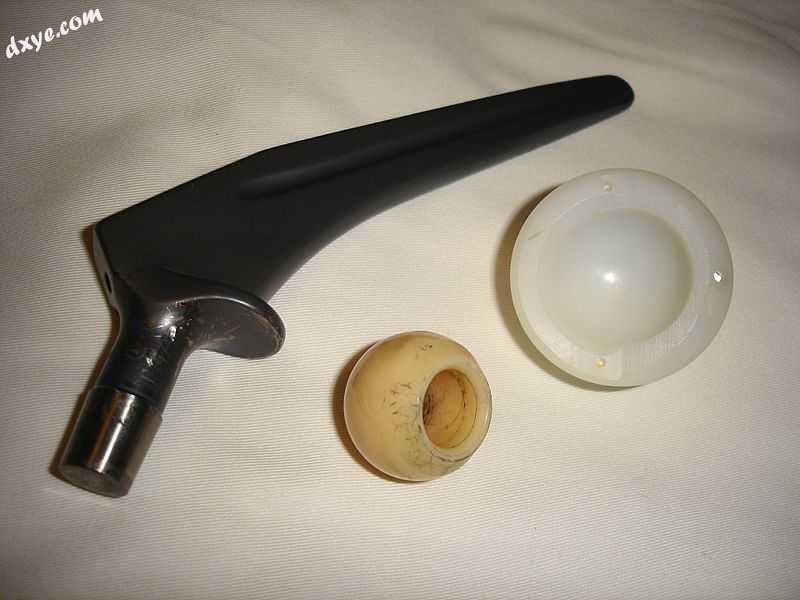 A titanium hip prosthesis, with a ceramic head and polyethylene acetabular cup.jpg