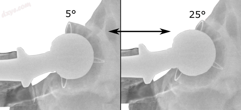 Acetabular anteversion is normally between 5 and 25°.[7] An anteversi.png