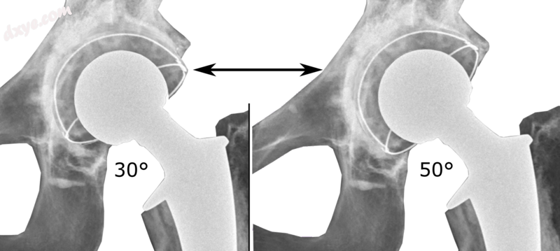 Acetabular inclination is normally between 30 and 50°.[60] A larger angle incre.png