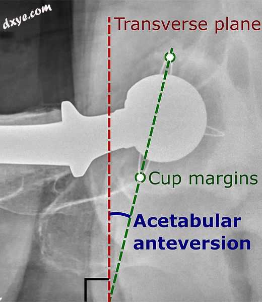 Acetabular anteversion.[61] This parameter is calculated on a lateral radiograph.jpg
