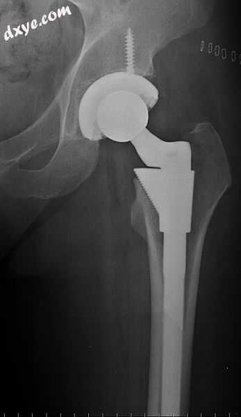 Cement-free implant sixteen days after surgery. Femoral comp.jpg