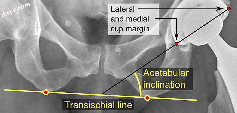 Acetabular inclination.[60] This parameter is calculated on an a.jpg