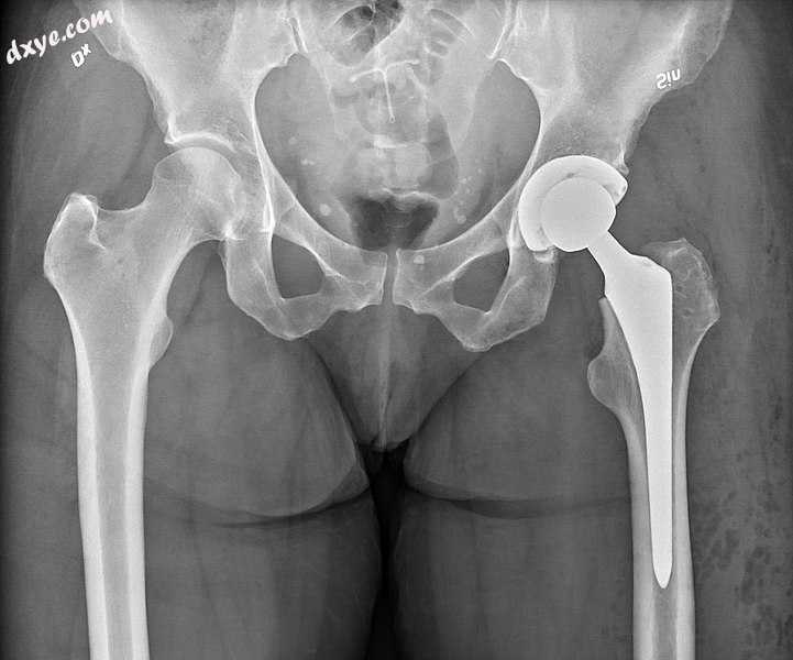 An X-ray showing a left hip (right of image) that has been replaced, with the ba.jpg