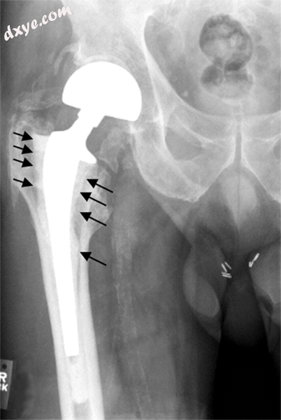 Hip prosthesis displaying aseptic loosening (arrows).png