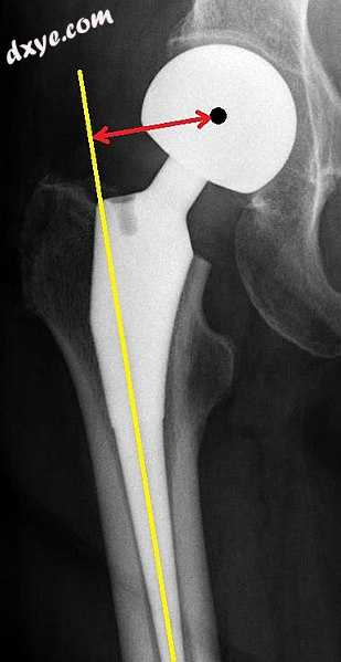 Femoral (neck) offset is defined as the perpendicular distance between th.jpg