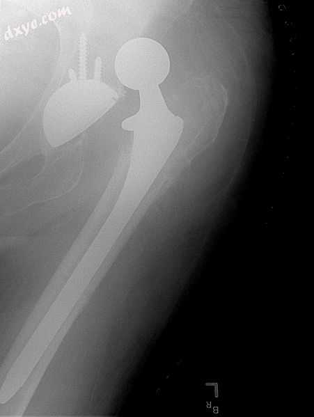 Dislocated artificial hip.jpg