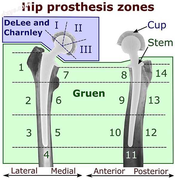 Hip prosthesis zones according to DeLee and Charnley,[15] and Gruen.[16] These a.jpg