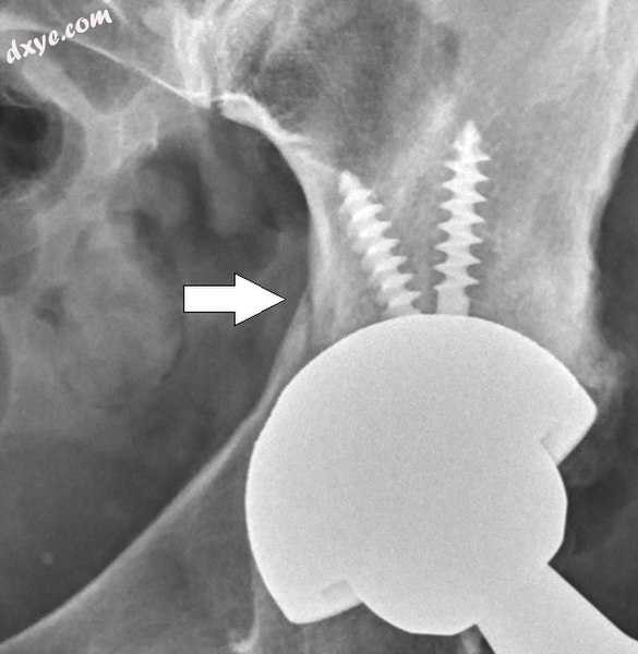 Intraoperative acetabular fracture..jpg