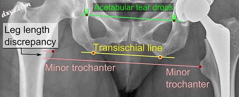 Leg length discrepancy after hip replacement is calculated as th.jpg