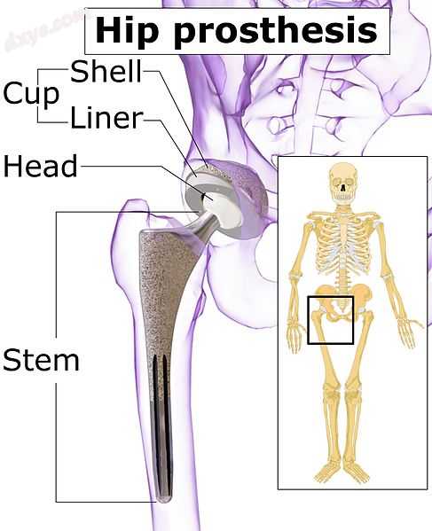 Main components of a hip prosthesis[45].jpg