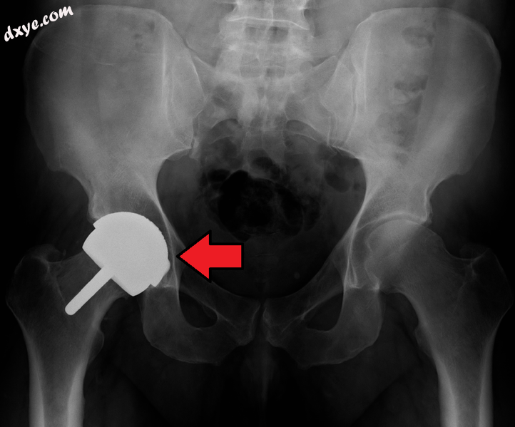 Metal on metal prosthetic hip.png