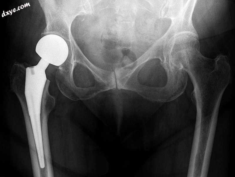 X-ray of the hips, with a right-sided hemiarthroplasty..jpg