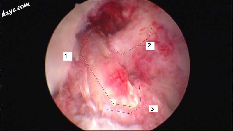 Arthroscopic anterior cruciate ligament.jpg