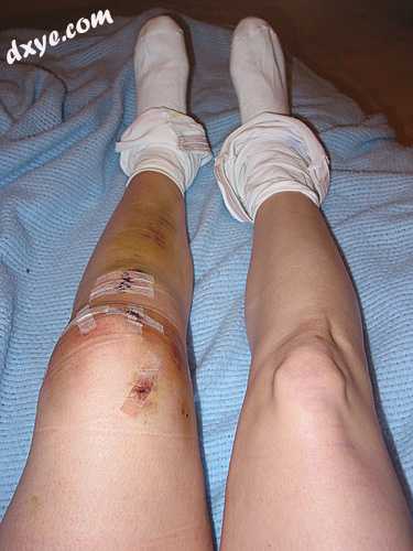 Left knee following hamstring autograft ACL reconstruction, par.jpg