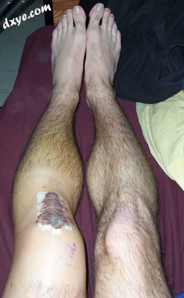 Knees following ACL reconstruction surgery. A patellar tendon graft was used. Di.jpg