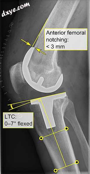- Anterior femoral notching (the femoral component causing reduced thickness of.jpg