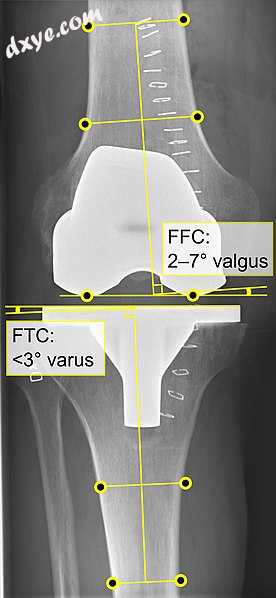 - FFC  frontal femoral component angle. It is typic.jpg