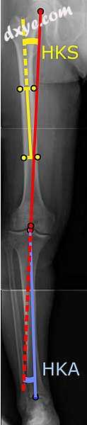 Angles commonly measured before knee replacement surgery.jpg