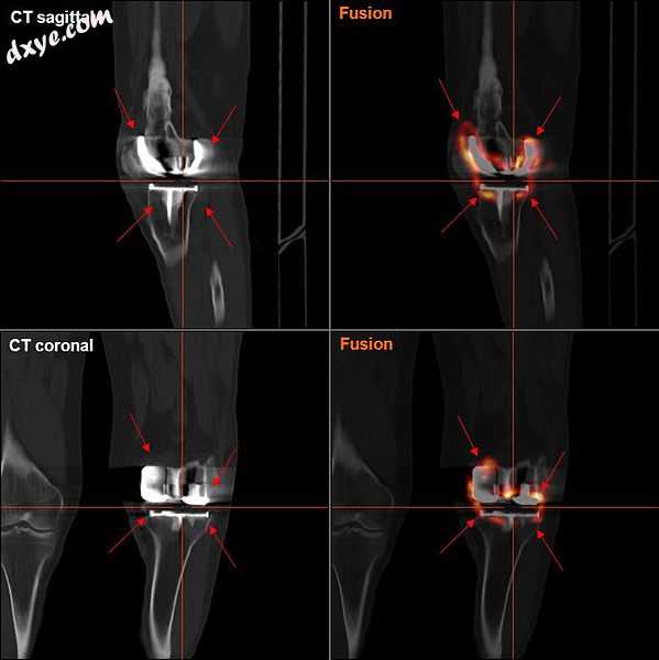 FDG-PET CT showing septic loosening of knee prothesis.jpg