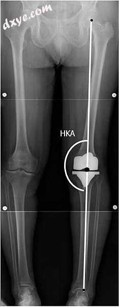 HKA Hip-knee-ankle angle, which is ideally between.jpg
