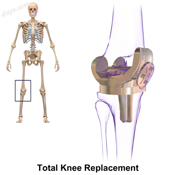 Knee replacement.png