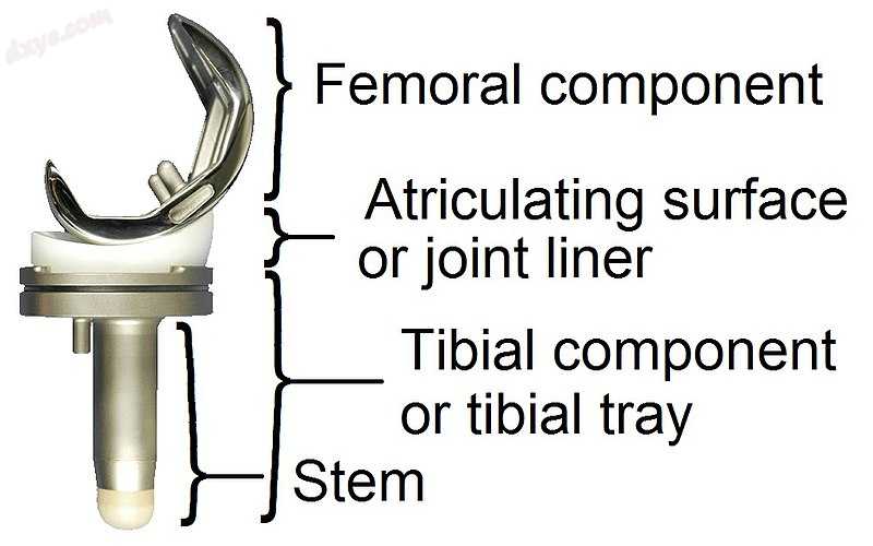 Main components of a knee prosthesis..jpg