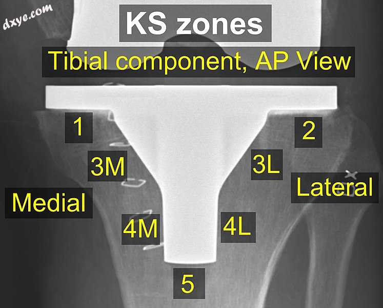 KS zones, anteroposterior (AP) view.[23].jpg