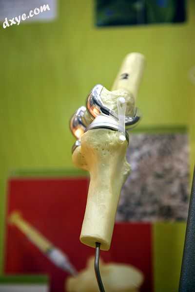 Model of total knee replacement.jpg