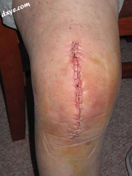 The incision for knee replacement surgery.jpg