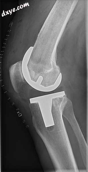 X-ray 2of total knee replacement, anteroposterior view (left) and lateral view (right).jpg