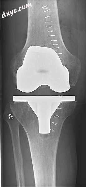 X-ray of total knee replacement, anteroposterior view (left) and lateral view (right).jpg