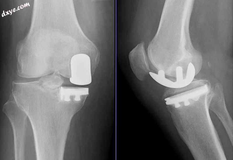 Radiographs of a knee arthroplasty of the medial compartment.jpg