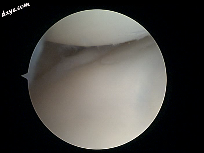 Arthroscopic view showing two of the wrist bones..png